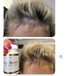 Porost nowych włosów po chemioterapii